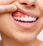 causes-bleeding-gums