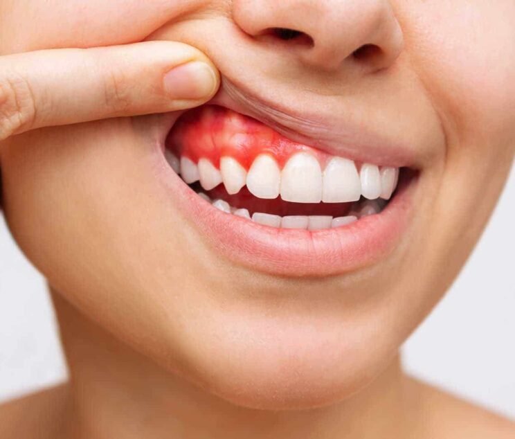causes-bleeding-gums